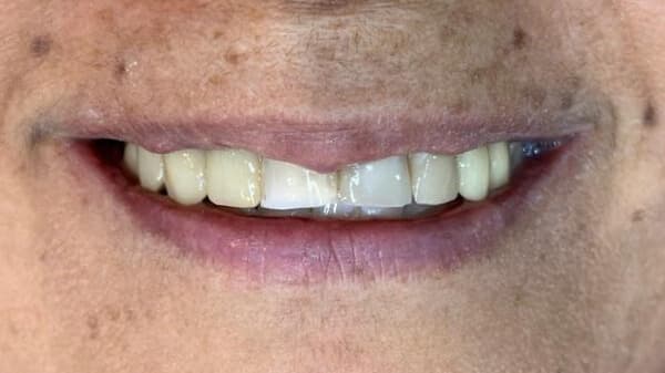 Depois do tratamento