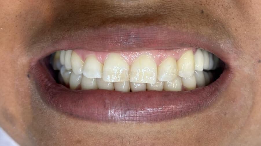 Depois do tratamento