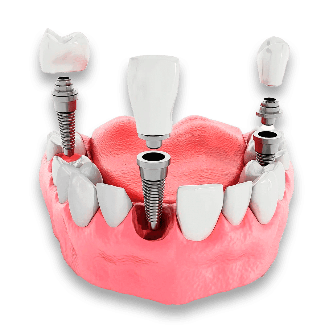 Implantes Múltiplos
